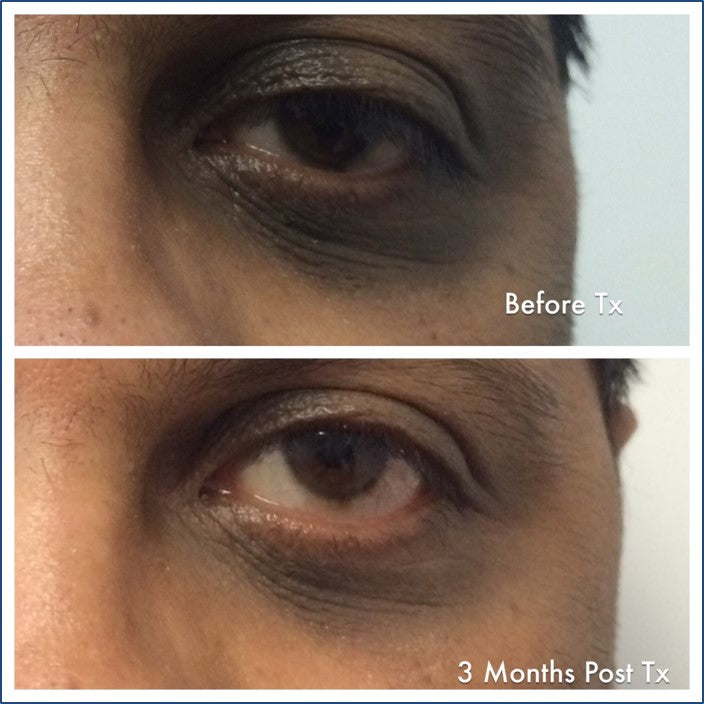 Eye repair cream discount